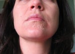 Day 3 peel 2